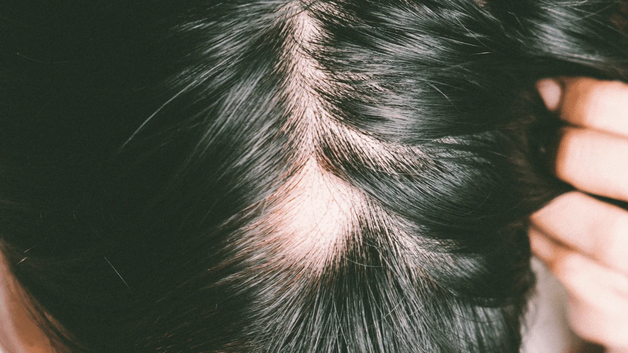 Alopecia