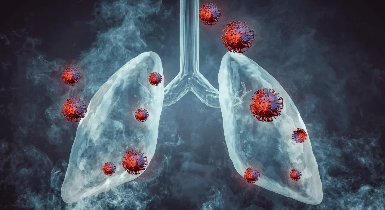 Bronchitis