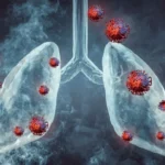 Bronchitis