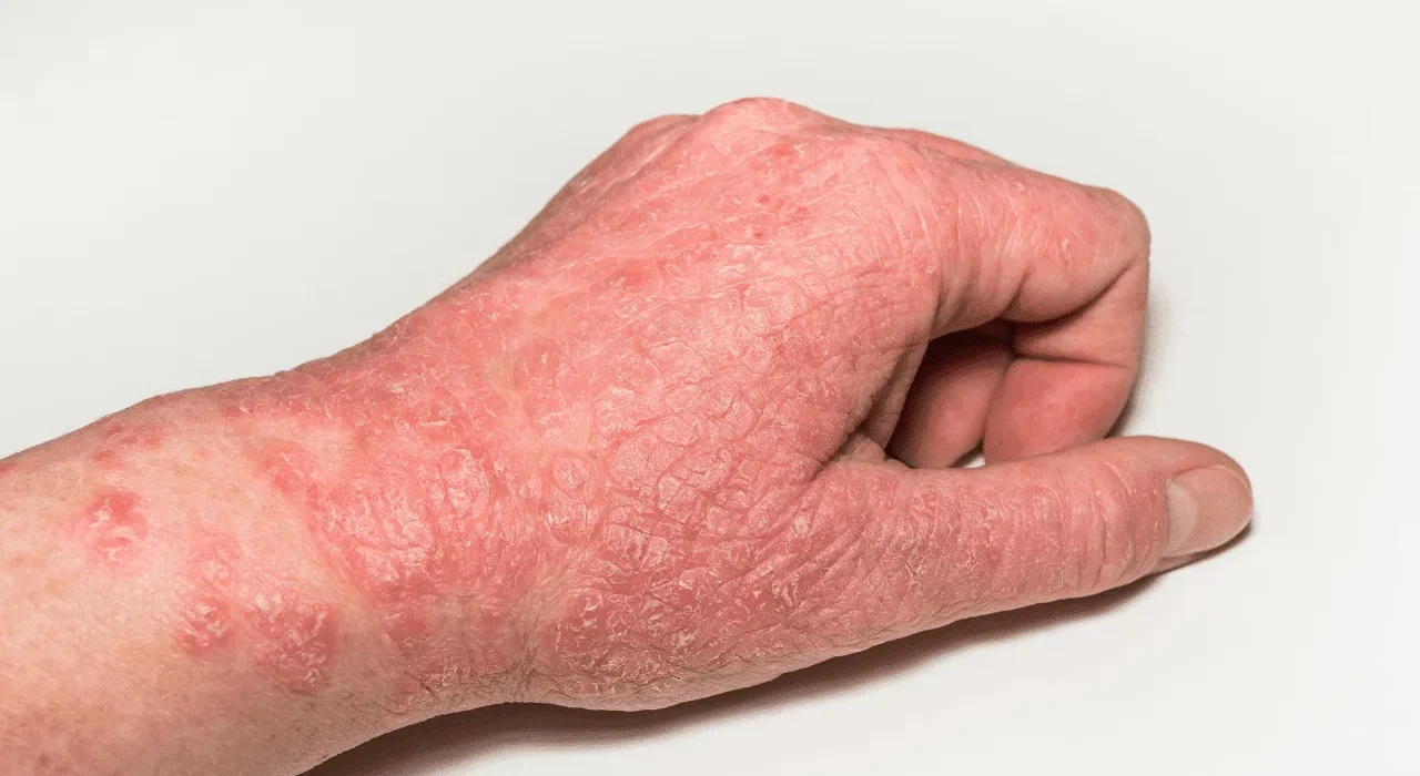 Eczema