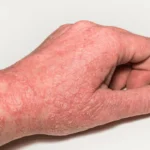 Eczema