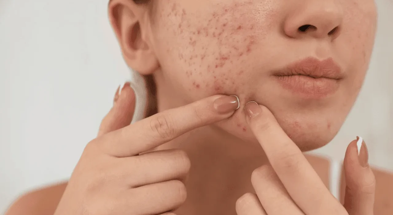 acne