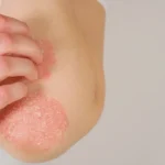 Psoriasis