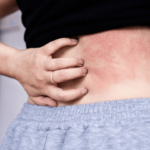 Skin Disorders - Rise and Shine